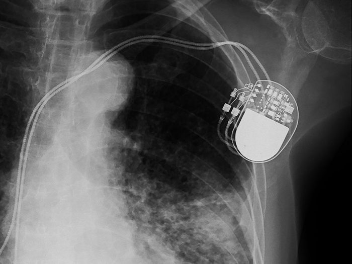 Stimulateurs cardiaques et défibrillateurs implantables peuvent être piratés à votre insu.
