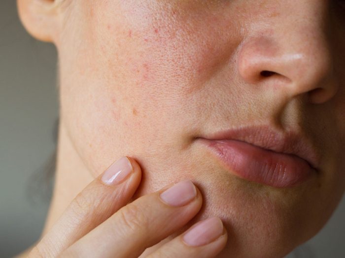 Si votre peau est jaunâtre, c'est un signe du cancer de la vésicule biliaire.