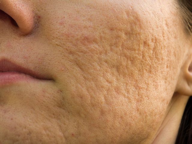 Concoctez une pte pour combattre l'acn et ses cicatrices.
