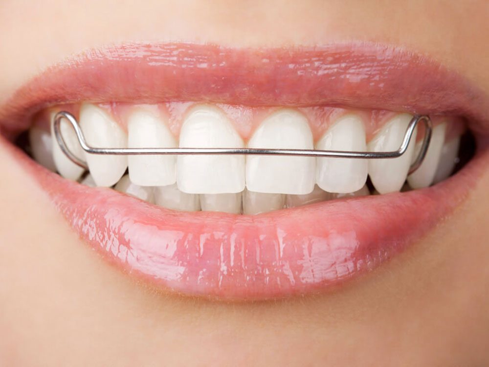 11 choses que votre orthodontiste ne vous dira pas
