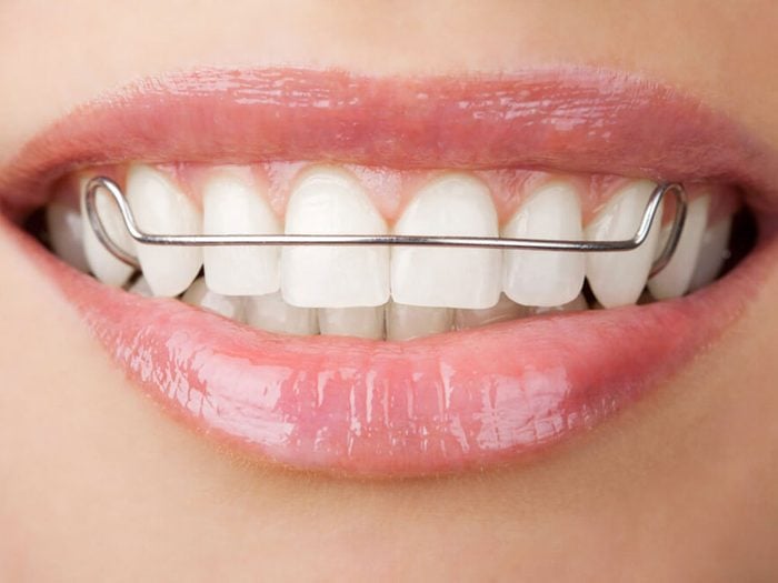 L'orthodontiste évitera de vous dire que vous devrez porter un appareil dentaire une fois votre traitement terminé.