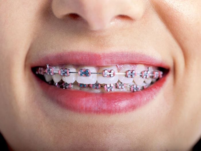 L'orthodontiste évitera de vous dire que quelqu’un d’autre a peut-être utilisé votre appareil dentaire avant vous.