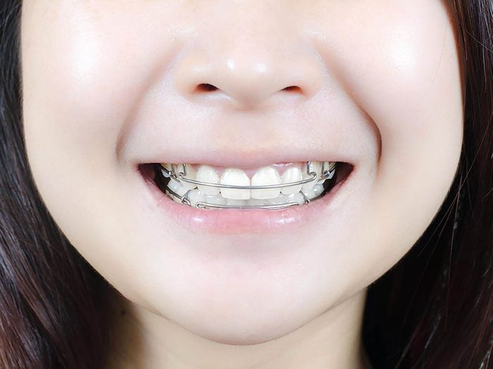 Même si vous pensez que votre enfant n’a pas besoin d’orthodontie, faites-le voir quand même.