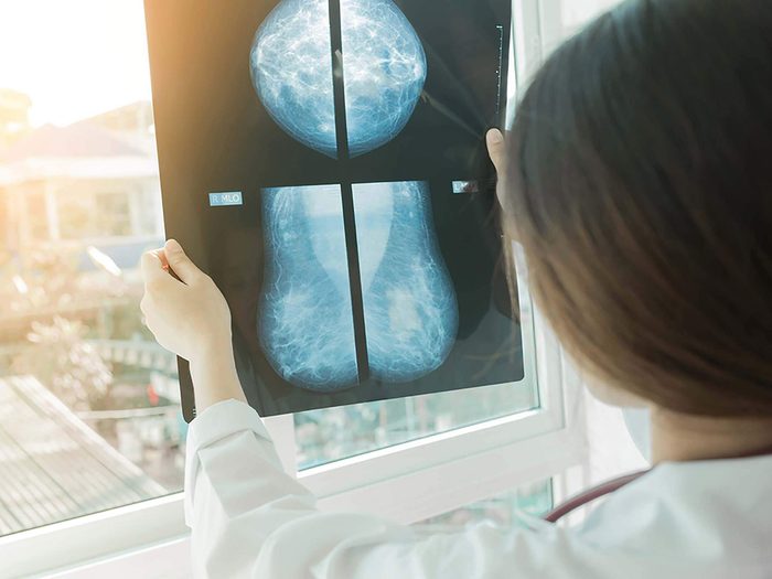 Mythes sur le cancer: la mammographie permet de trouver tous les cancers du sein