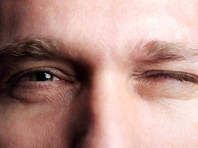 Symptme de commotion crbrale: une dilatation irrgulire des pupilles.