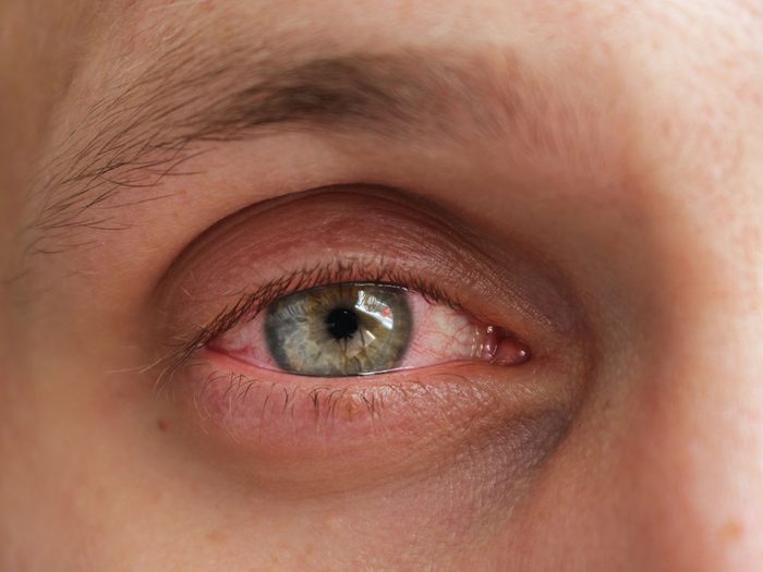 L'inflammation oculaire est l'un des symptômes de la COVID-19.