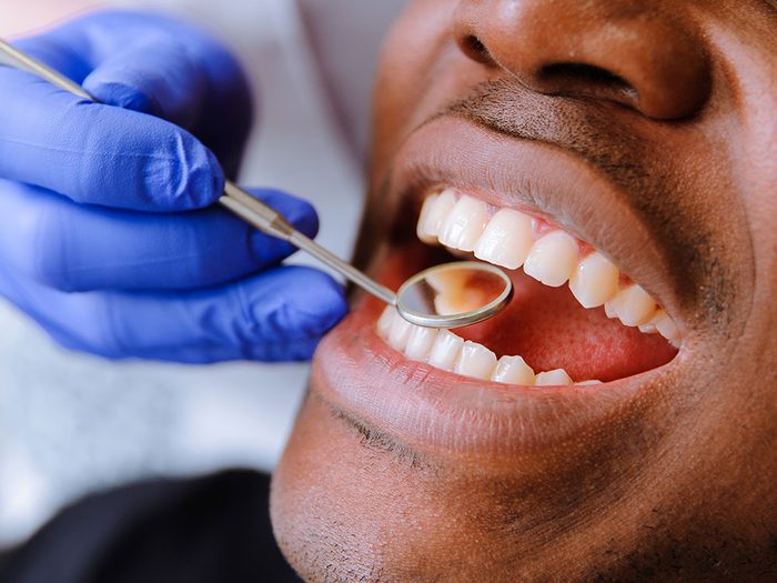 Comment prévenir la carie dentaire?