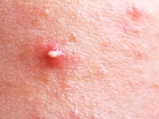 L'acn peut apparatre en changeant de soins de la peau.