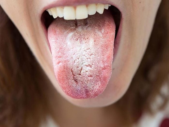 Si l'aspect de la langue est d'un blanc crémeux c'est que vous avez une infection provoquée par des levures.