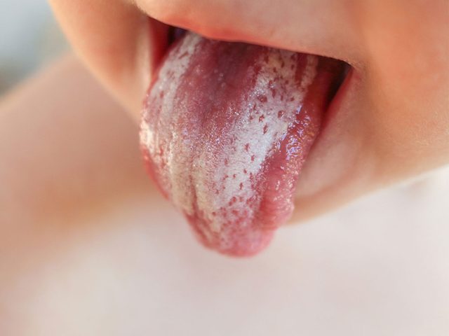 Si l'aspect de la langue est tachete de blanc c'est que quelque chose irrite votre bouche.