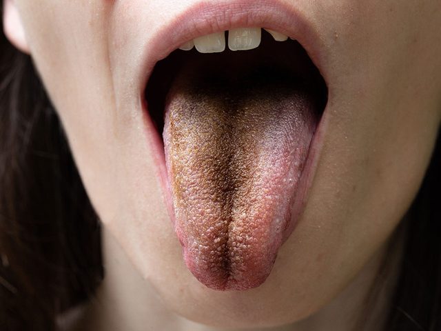 Si l'aspect de la langue est noir ou brun c'est que vous navez pas une trs bonne hygine buccale.