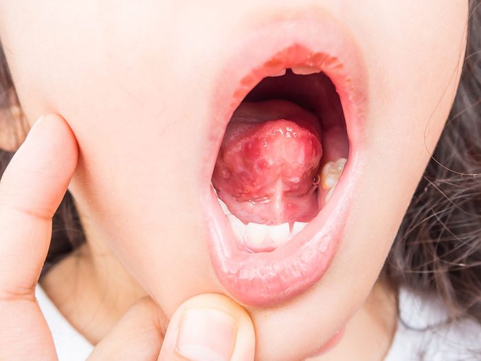 Si l'aspect de la langue est framboisé, faites attention aux carences en vitamines.