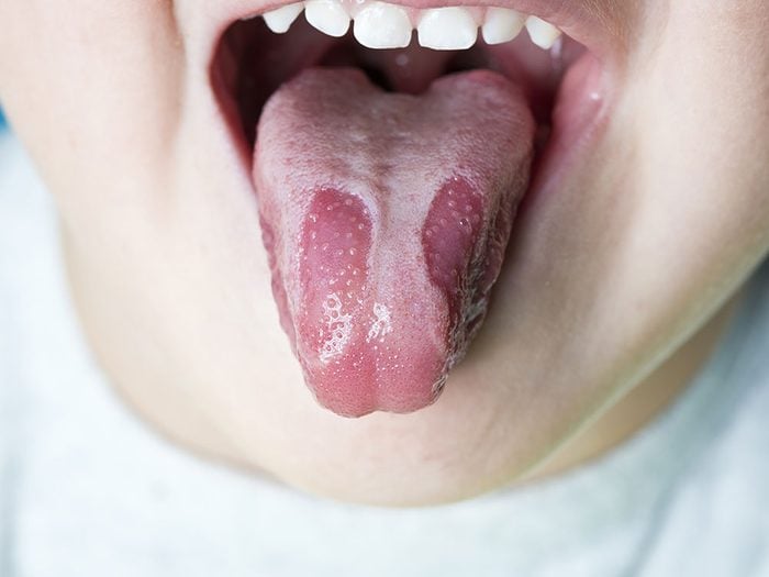 Avoir une langue d’aspect unique ne signifie pas que vous avez une maladie de la langue.