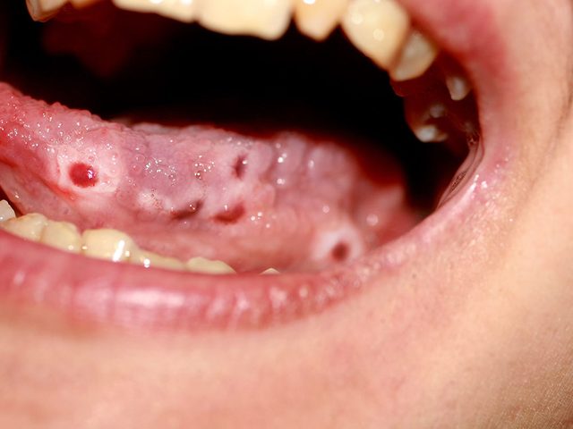 Si l'aspect de la langue est rouge et plein de lsions cela pourrait tre une indication dune maladie plus grave de la langue. 