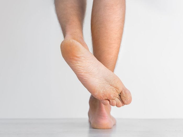 Les pieds secs et squameux peuvent être révélateurs de maladies.