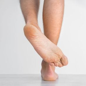 Les pieds secs et squameux peuvent tre rvlateurs de maladies.