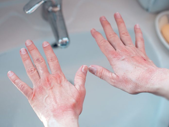Le psoriasis ou l’eczéma peuvent faire apparaitre une tache blanche sur un ongle.