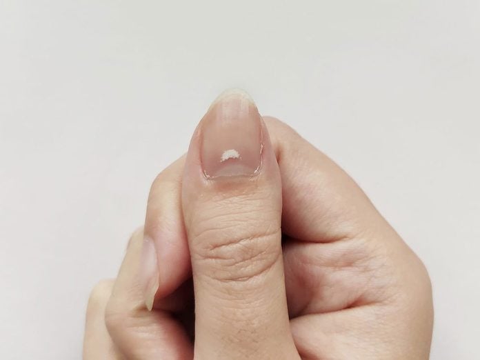 Vous avez peut-être vu apparaître une tache blanche sur un ongle à la suite d'un choc.