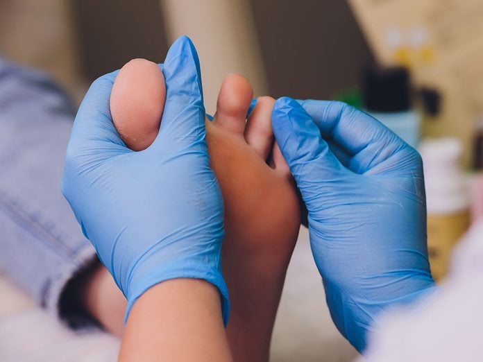 L’onychogryphose peut causer des ongles d'orteils très épais.