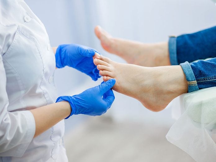 Qu’arrive-t-il aux ongles d’orteils très épais dus à l’onychomycose?