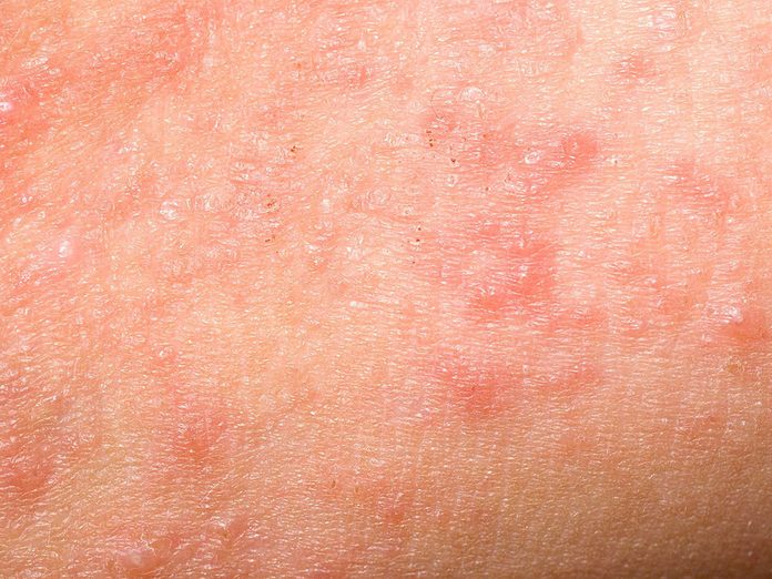 Soins de la peau: la rosacée peut ressembler à de l’acné.