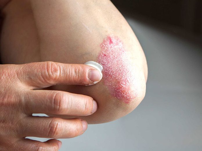 Soins de la peau: le psoriasis n'est pas contagieux.
