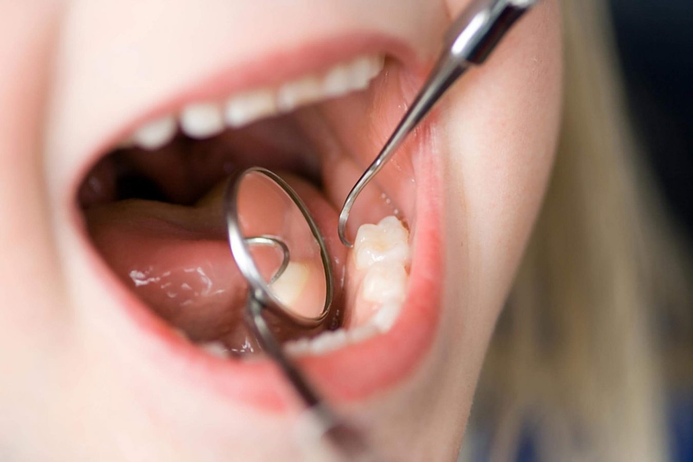 Les morsures des joues et de la langue. — Conseil Dentaire Dr