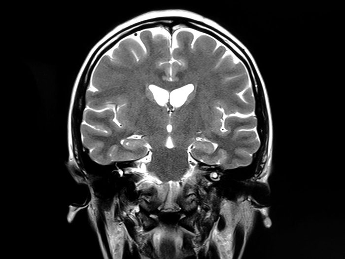 Alzheimer: des régions distinctes du cerveau.