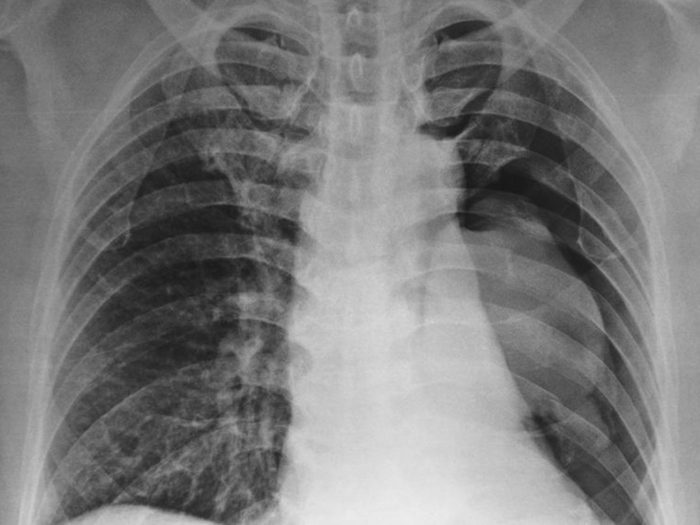 Les poumons redeviennent capables de combattre l’infection quand on arrête de vapoter.