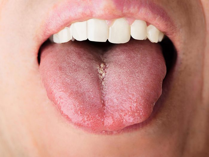 Avoir mal à la bouche fait partie des signes d'une carence en fer.