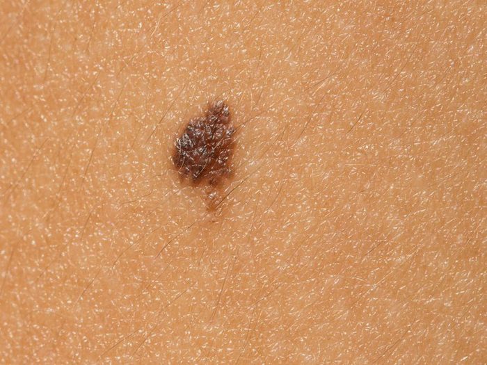 Mythe: des grains de beauté en petit nombre signifient un faible risque d’avoir un cancer de la peau.