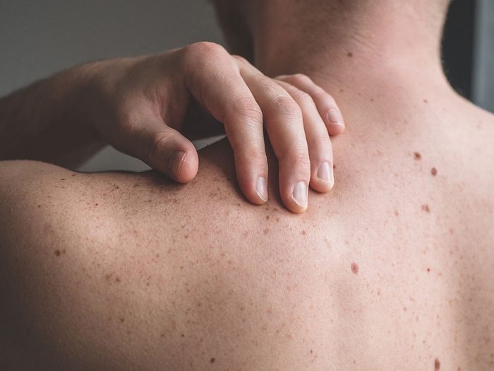 Quels sont les mythes sur le cancer de la peau qu’il faut cesser de croire?