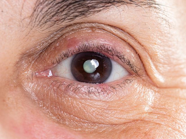 Perte de vision:  50ans, Dorothy Woodend avait une cataracte.
