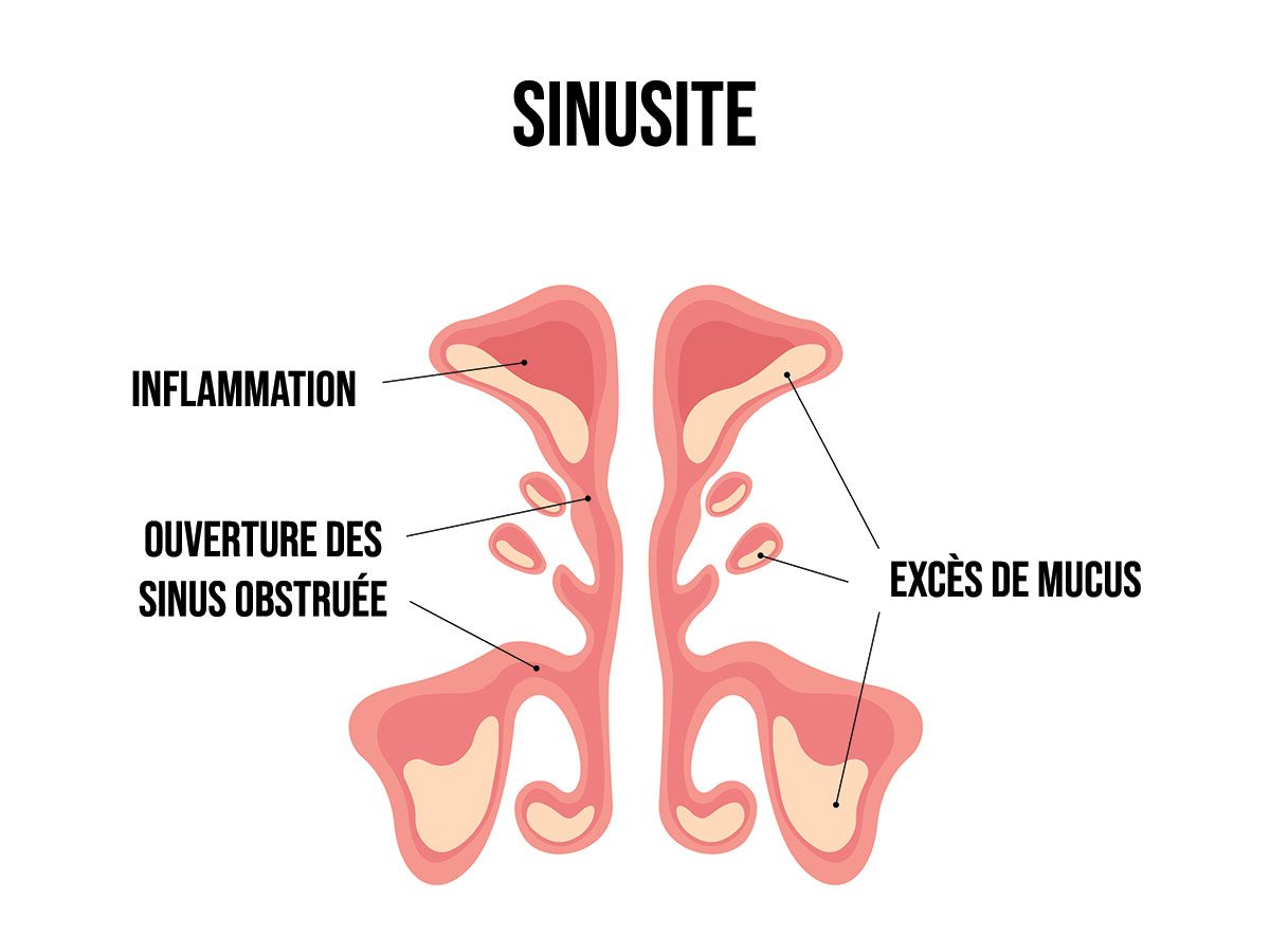 5 symptômes évidents d'une sinusite