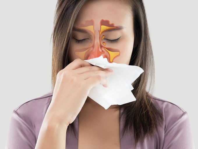 Sinusite allergique: que font les sinus?