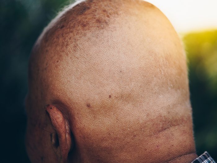 Le cancer de la peau peut être à l'origine d'un cuir chevelu qui démange.