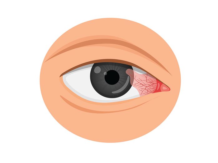Faut-il s'inquiéter si on a une tache rouge dans l'oeil comme symptôme?
