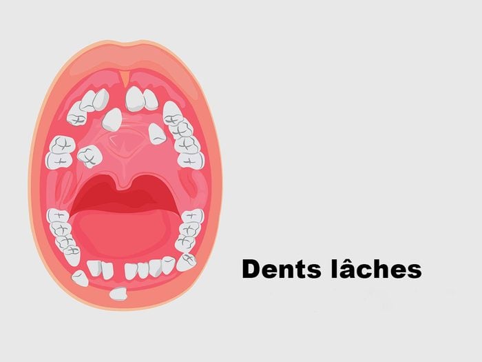 Les dents laches peuvent signifier un cancer de la bouche