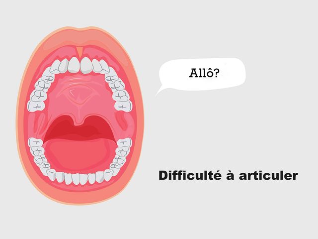 Avoir de la difficult  articuler peut tre un signe du cancer de la bouche
