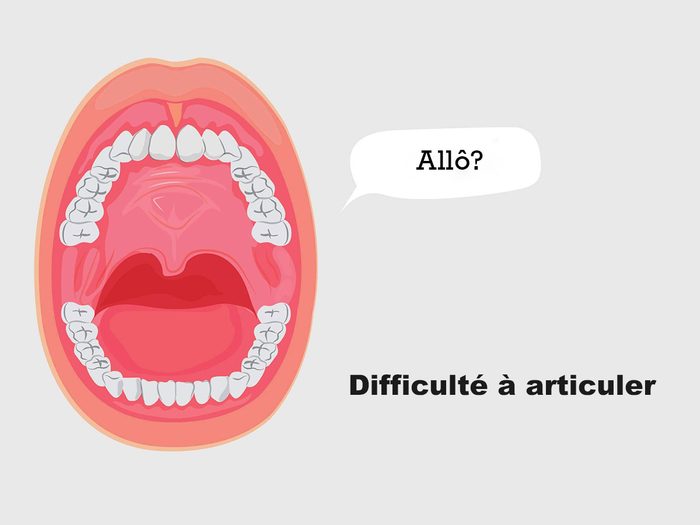 Avoir de la difficulté à articuler peut être un signe du cancer de la bouche