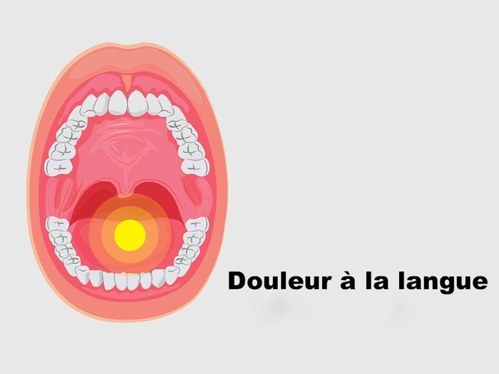 Une douleur à la langue peut être un signe du cancer de la langue
