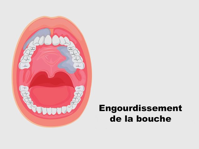 L'engourdissement de la bouche signifie peut-tre un cancer de la bouche