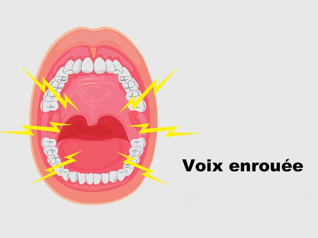 La voix enroue est un symptme du cancer de la bouche