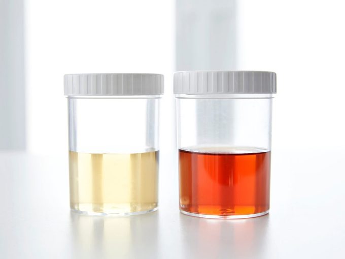 Qu'est-ce que la couleur de votre urine peut révéler sur votre santé?