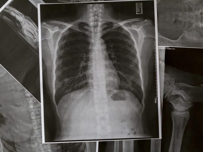 Radiographies De Poumons
