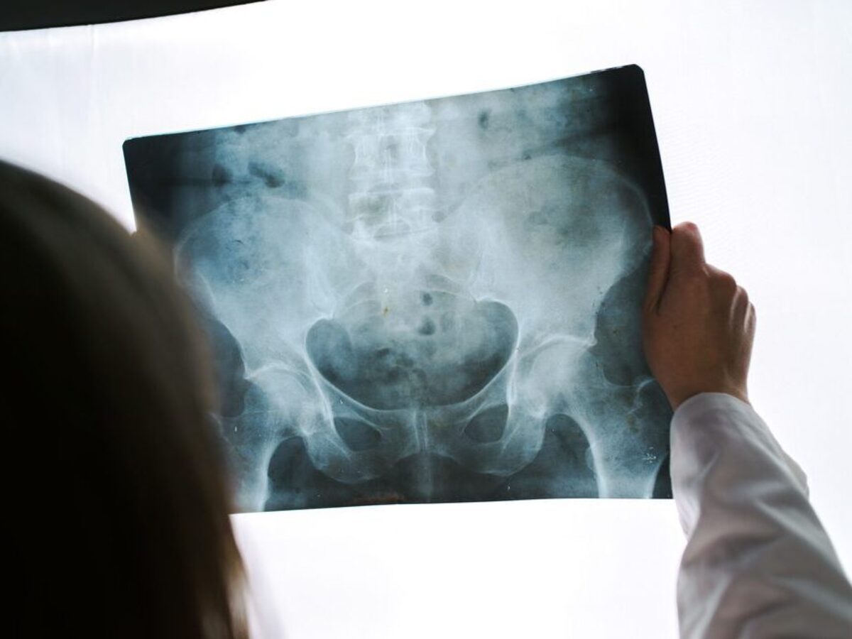 Radiographie De La Hanche Medecin