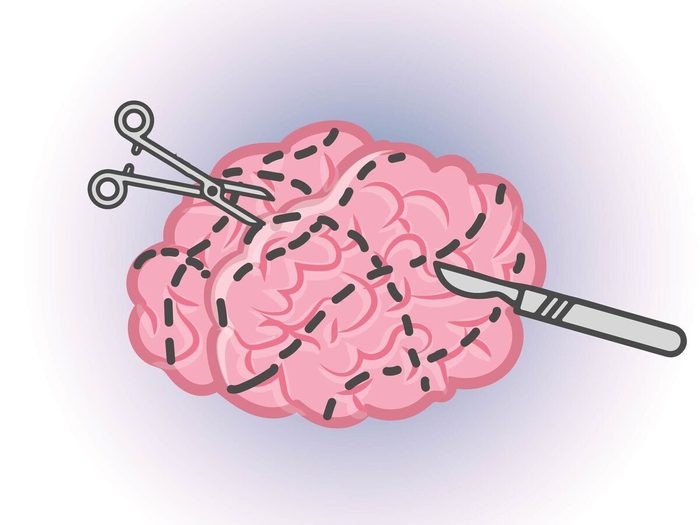 L Ablation Chirurgicale Du Cerveau N Affecte Pas La Personnalite Ni La Memoire