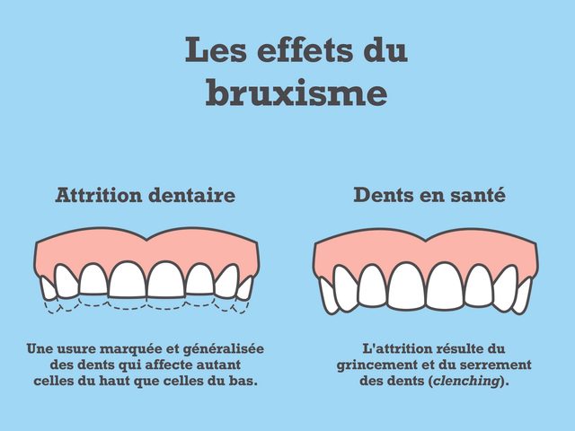 Les effets du bruxisme sur les dents.