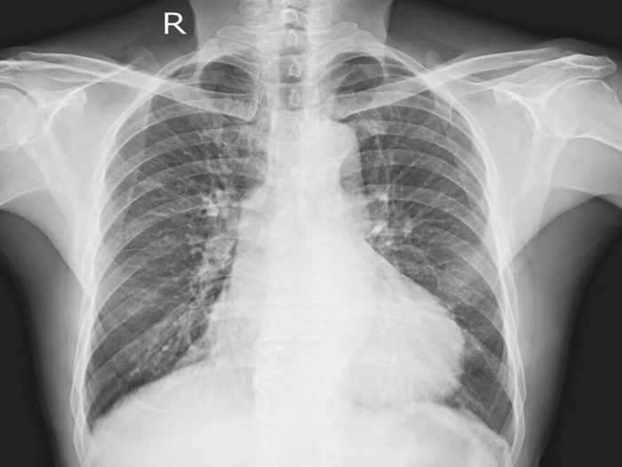 Infection Respiratoire Cage Thoracique Radiographie
