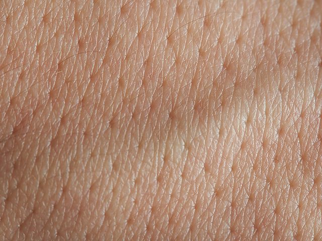Cicatrices acn: un plan rapproch de la peau.